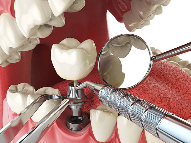 Best Knocked-Out Tooth (Avulsed Tooth) Treatment in Greene, RI